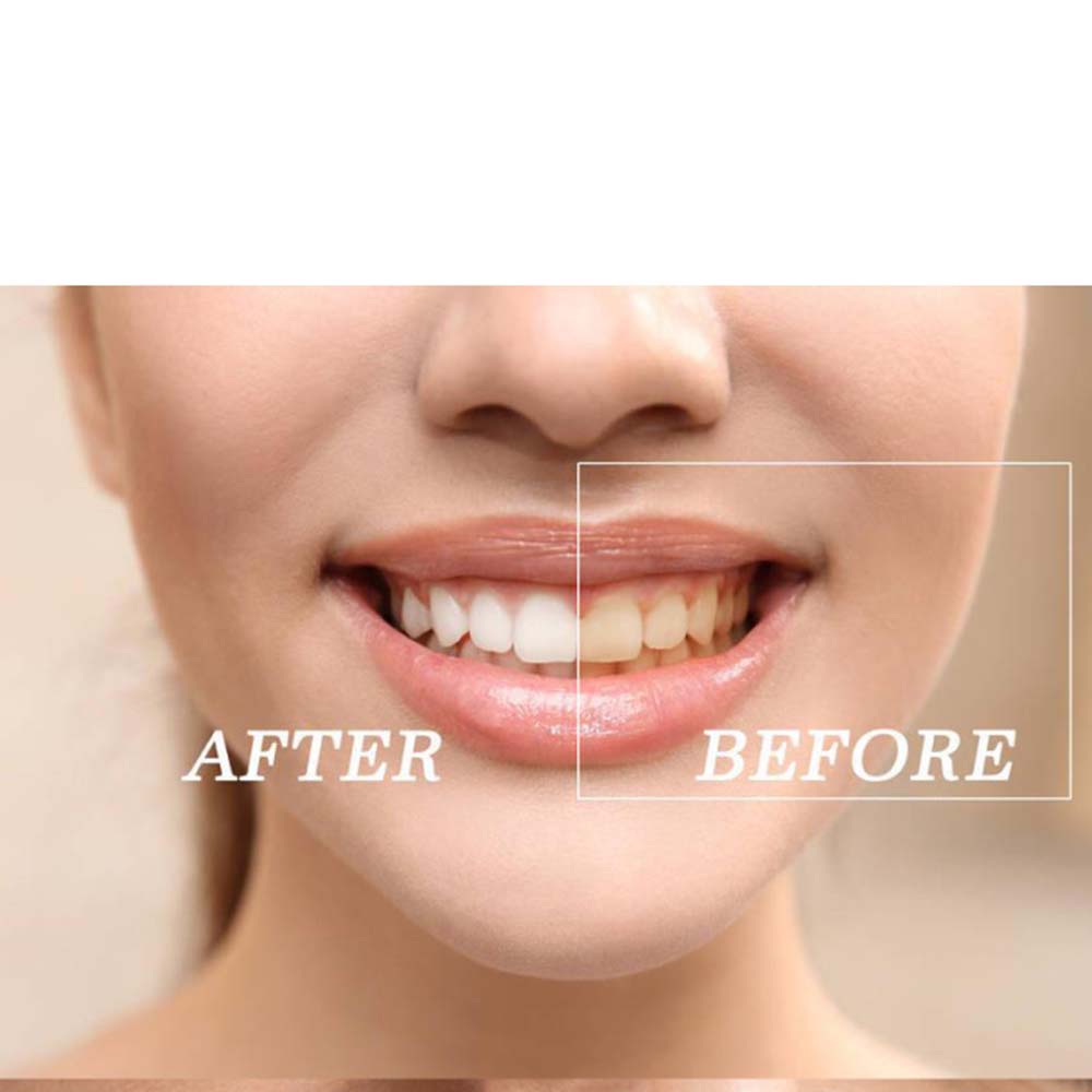 Top Quality Peroxide Teeth Whi - Teeth Whitening Kit With Light review and price