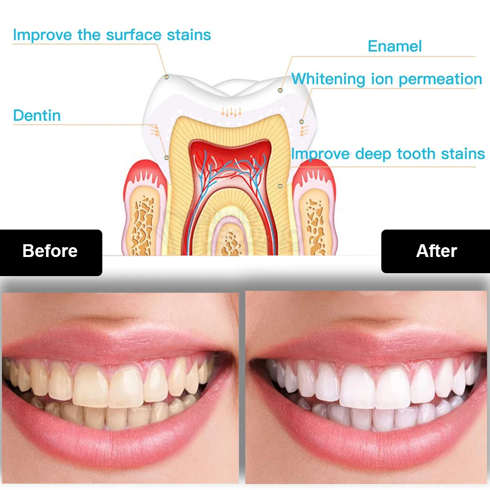 Dental Teeth Whitening Kit Min - Teeth Whitening For Trays review and price