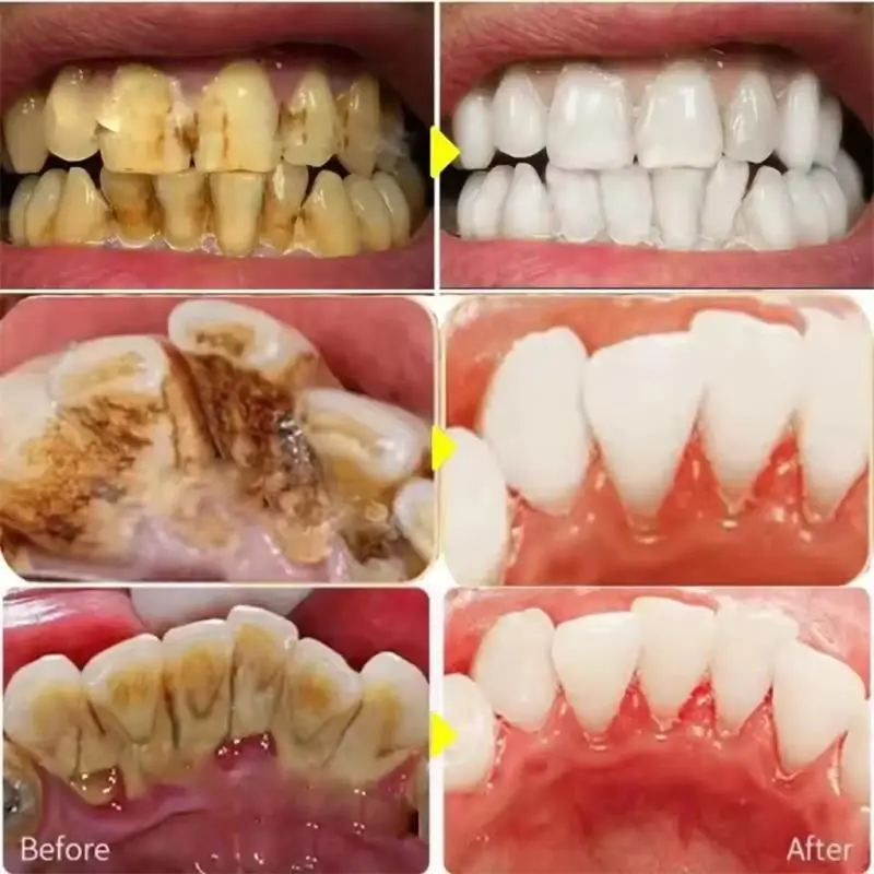 Fast Teeth Whtening Toothpaste - Whitening Pen Bleach review and price