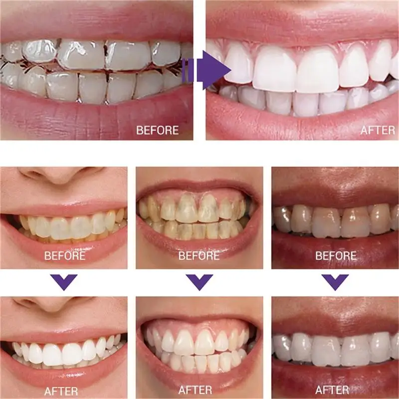 Fast Teeth Whtening Toothpaste - Whitening Pen Bleach review and price